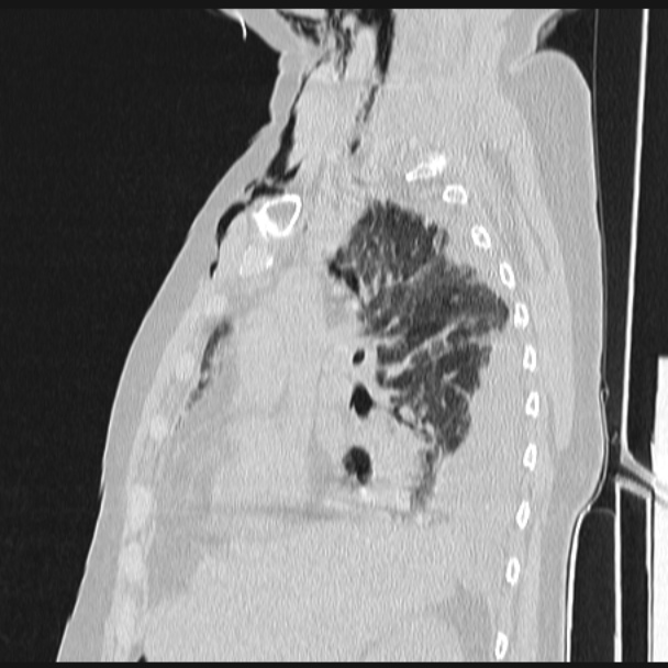 Boerhaave syndrome (Radiopaedia 45644-49799 Sagittal lung window 29).jpg