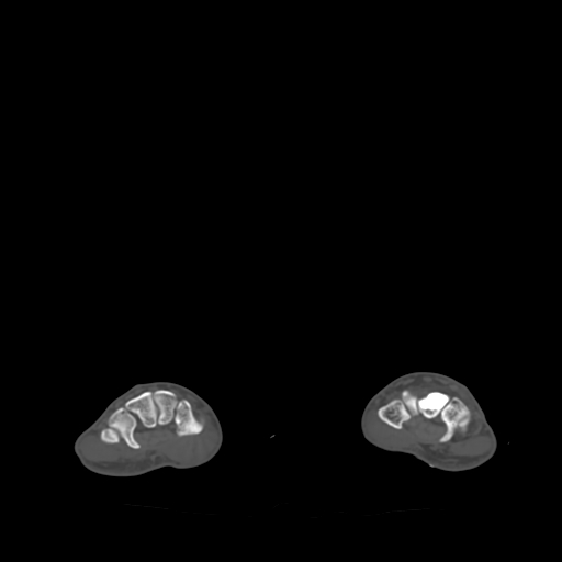 Bone islands - carpus (Radiopaedia 63141-71658 Axial bone window 33).jpg