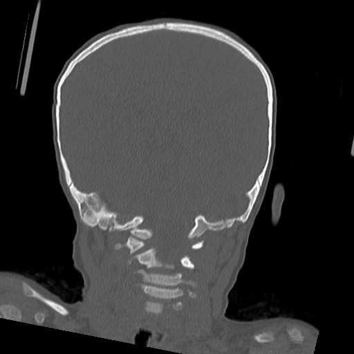 File:Bony atresia of the right external auditory canal (Radiopaedia 27916-28156 Coronal bone window 4).jpg