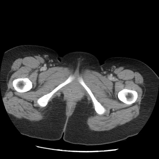 File:Borderline mucinous tumor (ovary) (Radiopaedia 78228-90808 A 144).jpg