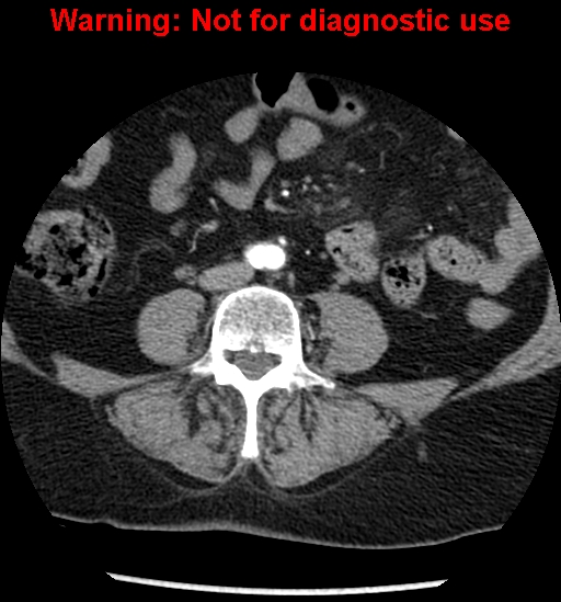 File:Bosniak renal cyst - type II (Radiopaedia 23404-23468 B 35).jpg