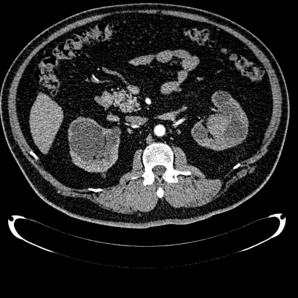 Bosniak renal cyst - type IV (Radiopaedia 24244-24518 B 137).jpg