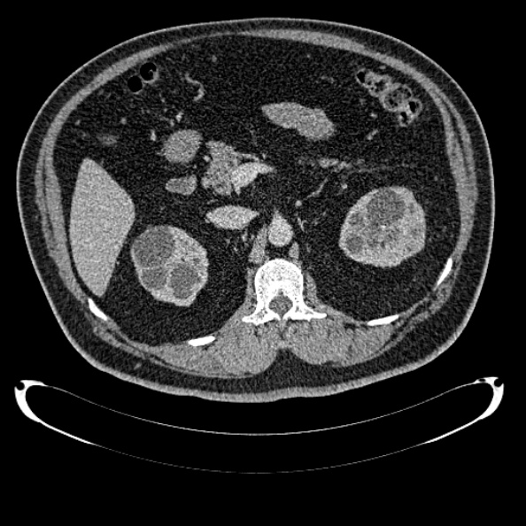 File:Bosniak renal cyst - type IV (Radiopaedia 24244-24518 C 119).jpg