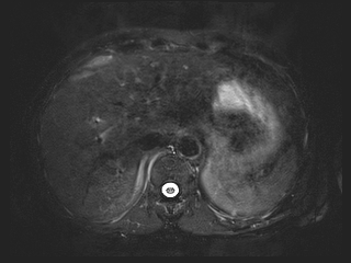 File:Bouveret syndrome (Radiopaedia 61017-68856 Axial MRCP 12).jpg