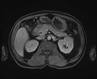Bouveret syndrome (Radiopaedia 61017-68856 Axial T1 C+ fat sat 38).jpg