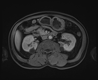 Bouveret syndrome (Radiopaedia 61017-68856 Axial T1 C+ fat sat 46).jpg