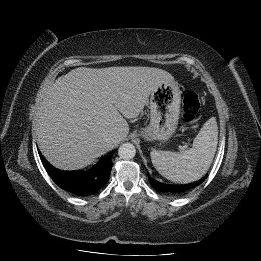 Bovine aortic arch - right internal mammary vein drains into the superior vena cava (Radiopaedia 63296-71875 A 151).jpg