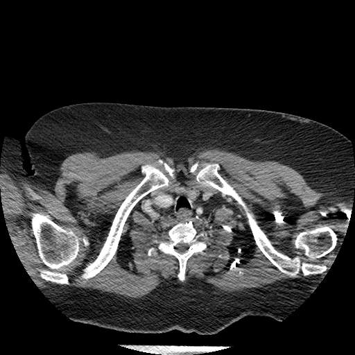 Bovine aortic arch - right internal mammary vein drains into the superior vena cava (Radiopaedia 63296-71875 A 2).jpg