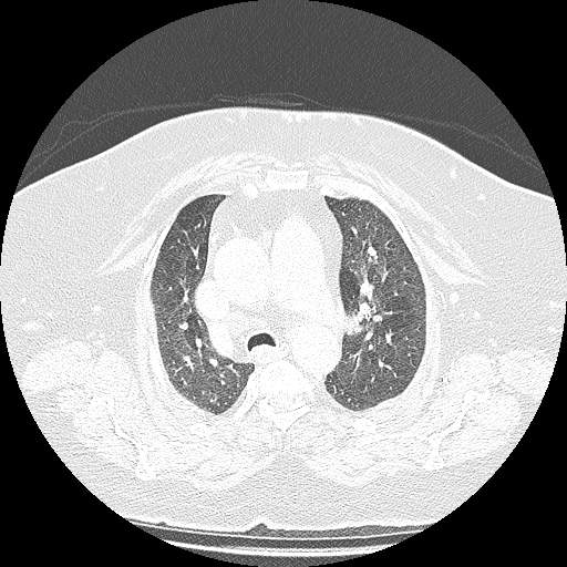 Bovine aortic arch - right internal mammary vein drains into the superior vena cava (Radiopaedia 63296-71875 Axial lung window 48).jpg