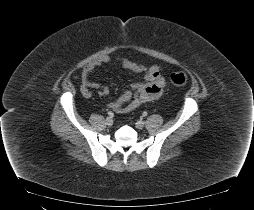 Bowel and splenic infarcts in acute lymphocytic leukemia (Radiopaedia 61055-68913 A 94).jpg
