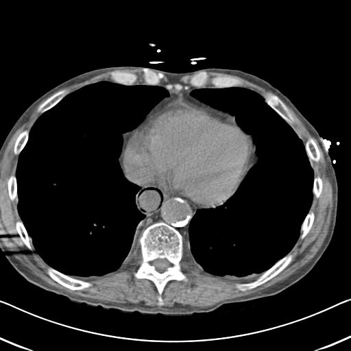 Bowel infarction (Radiopaedia 30296-30933 Axial non-contrast 2).jpg