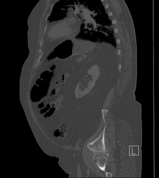 File:Bowel ischemia secondary to SMA occlusion with extensive portomesenteric venous gas (Radiopaedia 54656-60871 Sagittal bone window 29).jpg