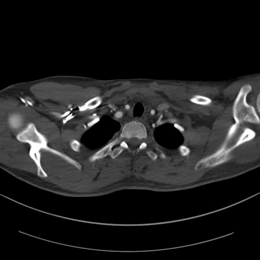 Brachiocephalic trunk pseudoaneurysm (Radiopaedia 70978-81191 Axial bone window 47).jpg