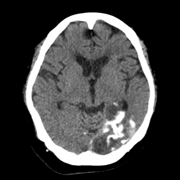 Brain cortical laminar necrosis (Radiopaedia 25822-25971 Axial non-contrast 20).jpg