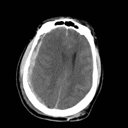 File:Brain death after motor vehicle collision (Radiopaedia 88470-105114 Axial 12).png