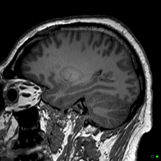 Brain death on MRI and CT angiography (Radiopaedia 42560-45689 Sagittal T1 54).jpg