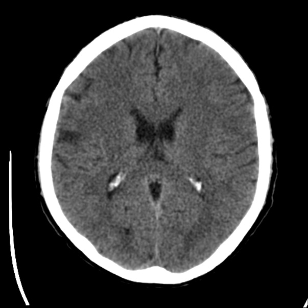 Brain metastases from lung cancer (Radiopaedia 24480-24781 Axial non-contrast 28).jpg