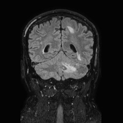 Brain metastases from lung cancer (Radiopaedia 83839-99028 Coronal FLAIR 58).jpg
