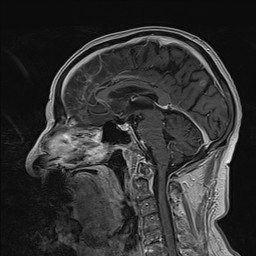 Brain metastasis (Radiopaedia 42617-45761 Sagittal T1 C+ 51).jpg