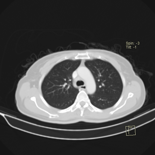 File:Brain metastasis as initial presentation of non-small cell lung cancer (Radiopaedia 65122-74127 Axial lung window 16).jpg
