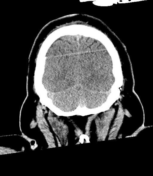 Brainstem hemorrhage (Radiopaedia 81294-94976 Coronal non-contrast 59).jpg