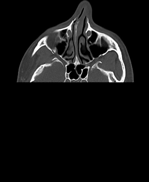 Branchial cleft cyst (Radiopaedia 31167-31875 Axial bone window 3).jpg