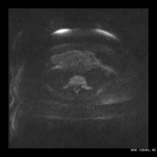 File:Broad ligament fibroid (Radiopaedia 49135-54241 Axial DWI 9).jpg