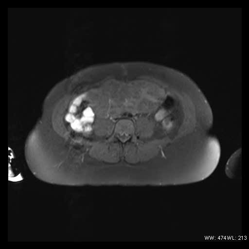 File:Broad ligament fibroid (Radiopaedia 49135-54241 Axial T1 fat sat 3).jpg
