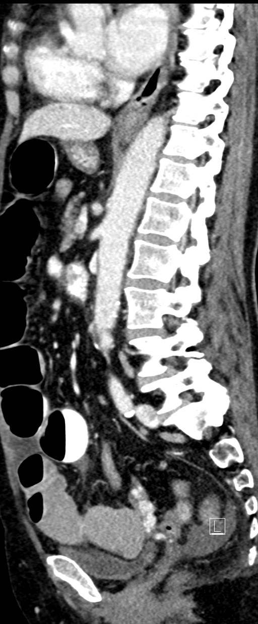Broad ligament hernia (Radiopaedia 84802-100276 C 34).jpg