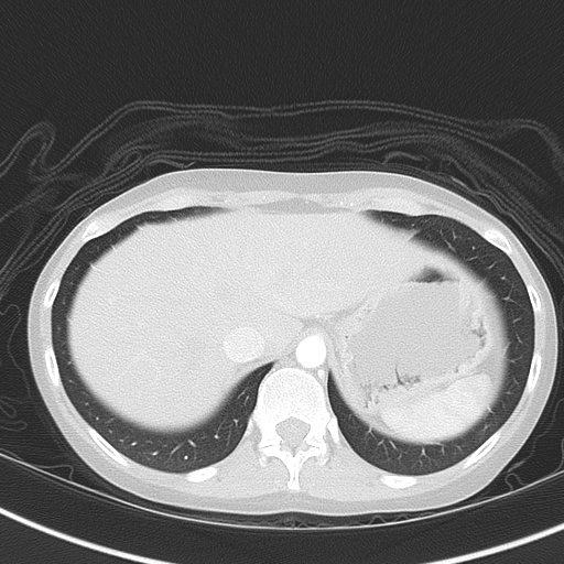Bronchial atresia (Radiopaedia 73677-84470 Axial lung window 52).jpg