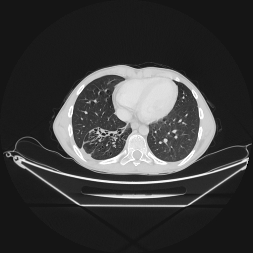 Bronchial carcinoid tumor (Radiopaedia 57187-64090 Axial lung window 59).jpg