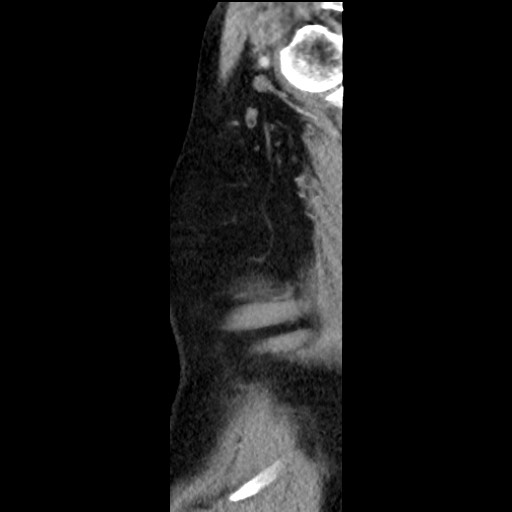 File:Bronchial carcinoid tumor (Radiopaedia 67377-76764 E 68).jpg