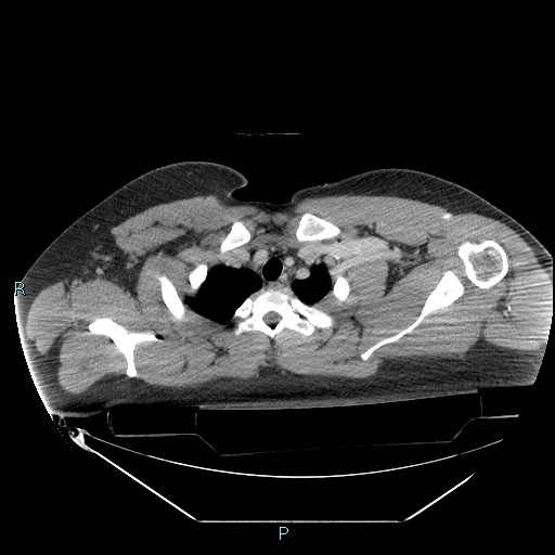 Bronchial carcinoid tumor (Radiopaedia 78272-90870 C 22).jpg
