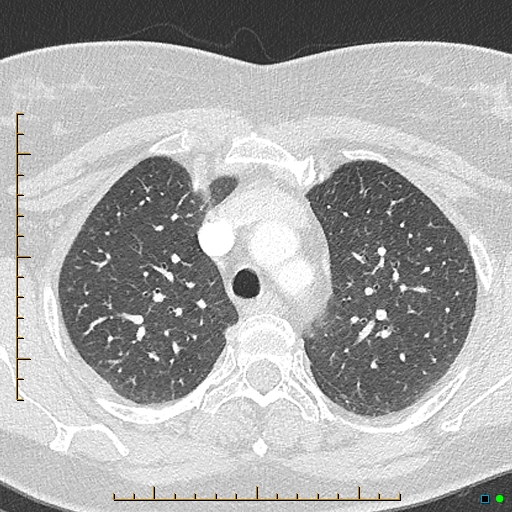 File:Bronchial diverticula (Radiopaedia 79512-92676 Axial lung window 44).jpg