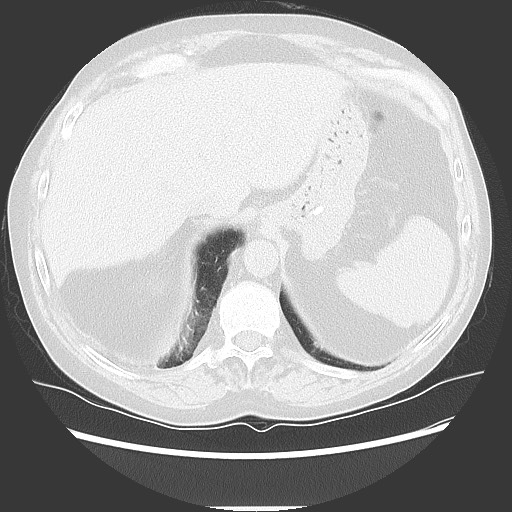 Bronchial stenosis - lung transplant (Radiopaedia 73133-83848 Axial lung window 54).jpg
