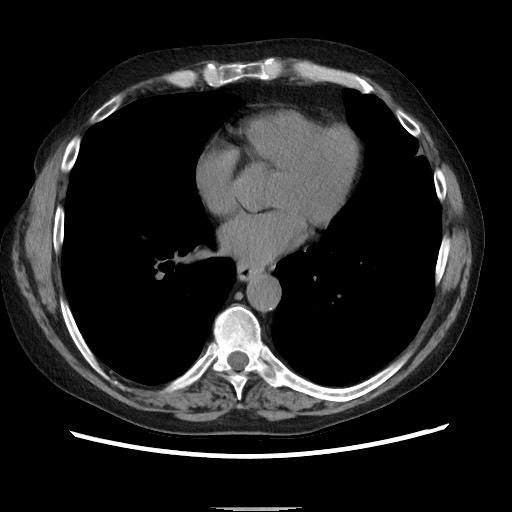 Bronchial stenosis - lung transplant (Radiopaedia 73133-83848 Axial non-contrast 40).jpg