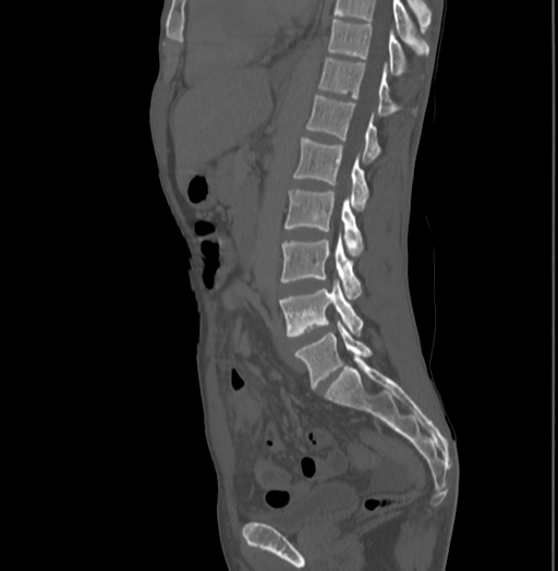 Bronchiectasis in Crohn disease (Radiopaedia 60311-67977 Sagittal bone window 135).jpg