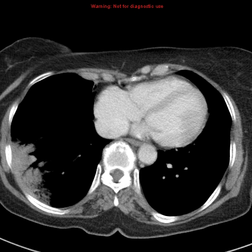 File:Bronchoalveolar carcinoma (BAC) (Radiopaedia 13436-13392 B 38).jpg