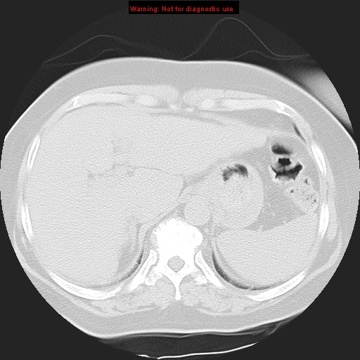 Bronchoalveolar carcinoma (Radiopaedia 13224-13233 Axial lung window 40).jpg