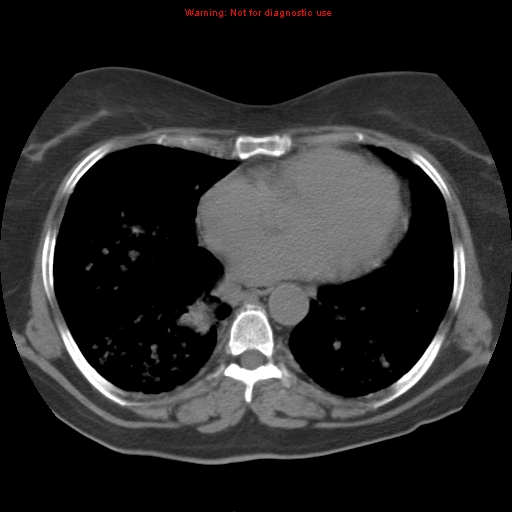 Bronchoalveolar carcinoma (Radiopaedia 13224-13233 Axial non-contrast 29).jpg
