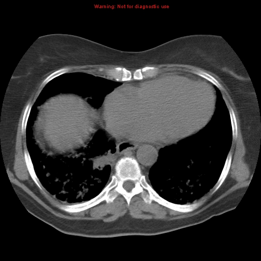 Bronchoalveolar carcinoma (Radiopaedia 13224-13233 Axial non-contrast 31).jpg