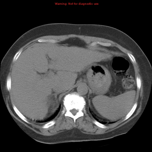 Bronchoalveolar carcinoma (Radiopaedia 13224-13233 Axial non-contrast 43).jpg
