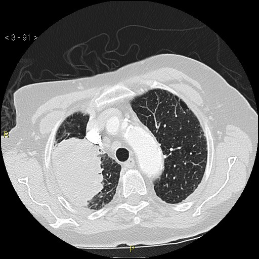 Bronchogenic carcinoma as an incidental finding (Radiopaedia 16453-16130 Axial lung window 91).jpg