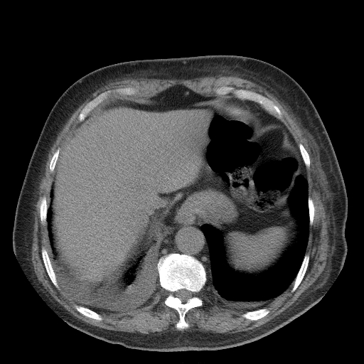Bronchogenic carcinoma with metastatic lymphadenopathy (Radiopaedia 37671-39569 Axial non-contrast 47).jpg