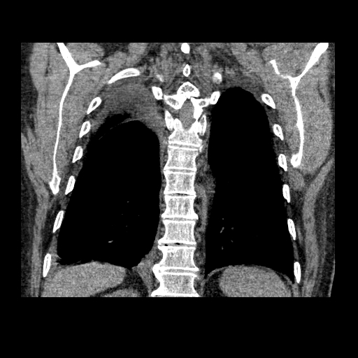 File:Bronchogenic carcinoma with metastatic lymphadenopathy (Radiopaedia 37671-39569 Coronal non-contrast 36).jpg