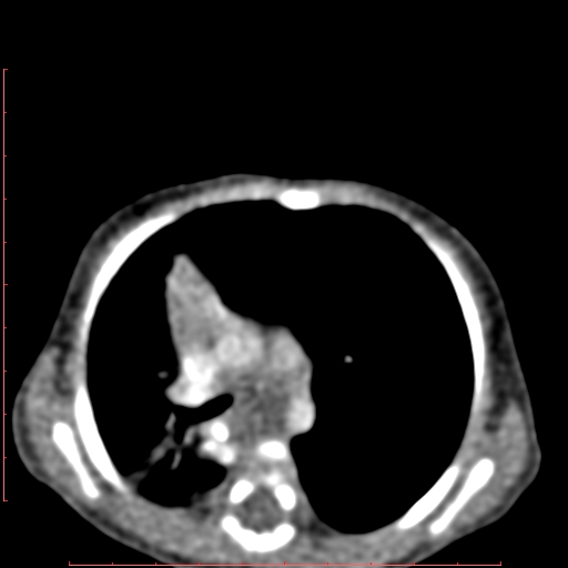 Bronchogenic cyst (Radiopaedia 78599-91409 B 89).jpg