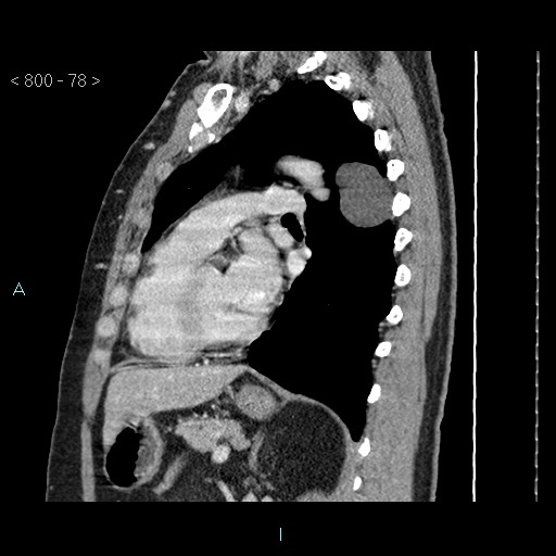 File:Bronchogenic cyst - posterior mediastinal (Radiopaedia 43885-47364 B 51).jpg