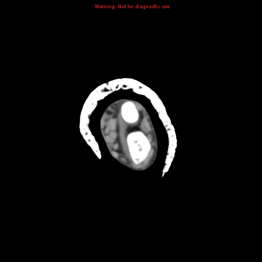 Brown tumor (Radiopaedia 12460-12694 Axial non-contrast 24).jpg