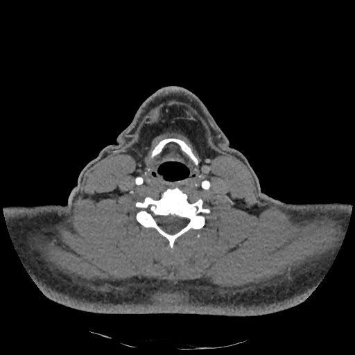 Buccal fat pad arteriovenous malformation (Radiopaedia 70936-81144 D 118).jpg