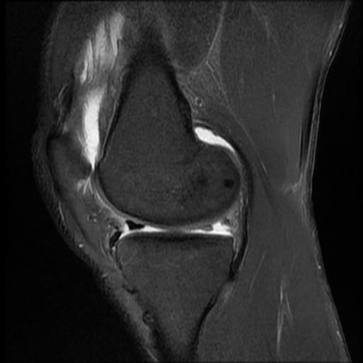 File:Bucket handle tear - medial meniscus (Radiopaedia 69245-79026 Sagittal PD fat sat 12).jpg